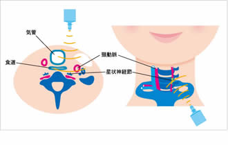 自律神経免疫療法(星状神経節レーザー照射)